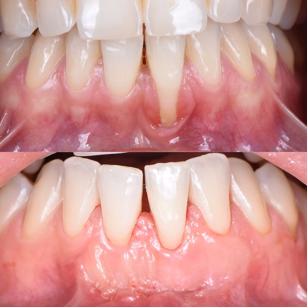 récession gingivale avant après greffe de gencive
