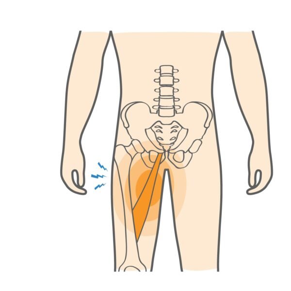 Groin Strain vs Groin Pull