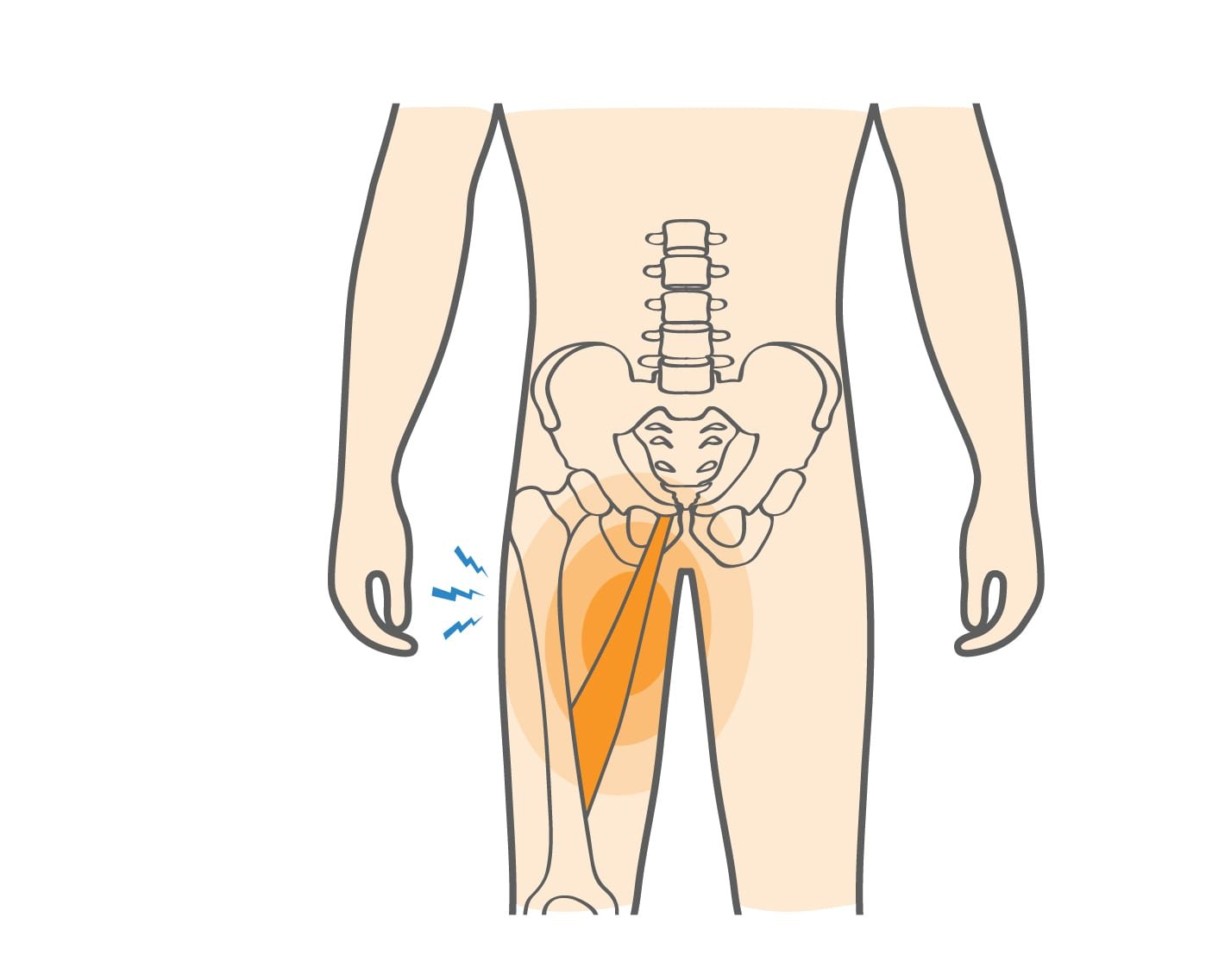 Groin Strain vs Groin Pull