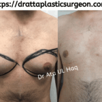 gynecomastia surgery in Lahore