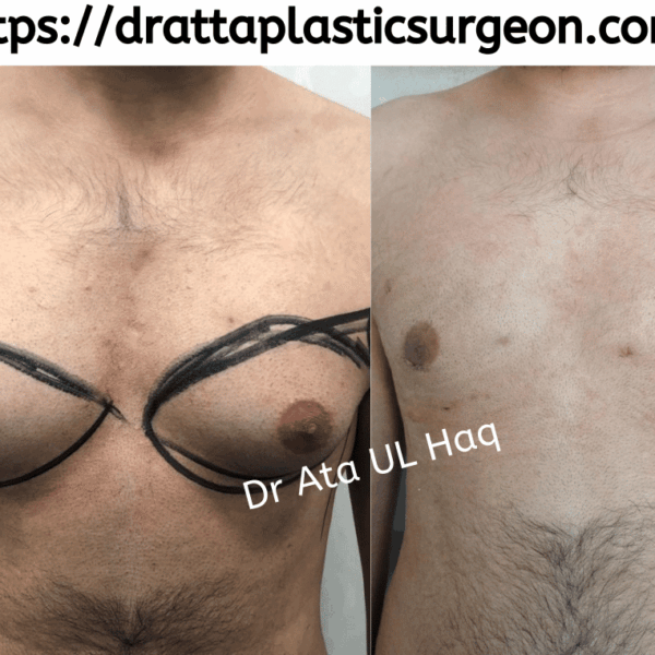gynecomastia surgery in Lahore