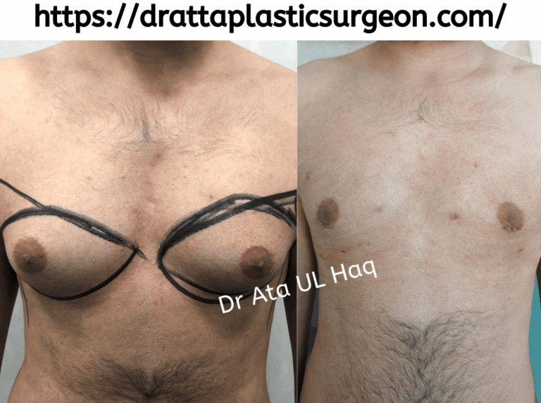 gynecomastia surgery in Lahore
