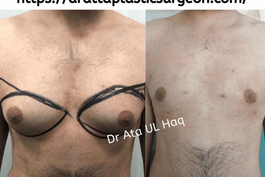 gynecomastia surgery in Lahore