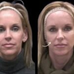 sculptra fillers in dubai
