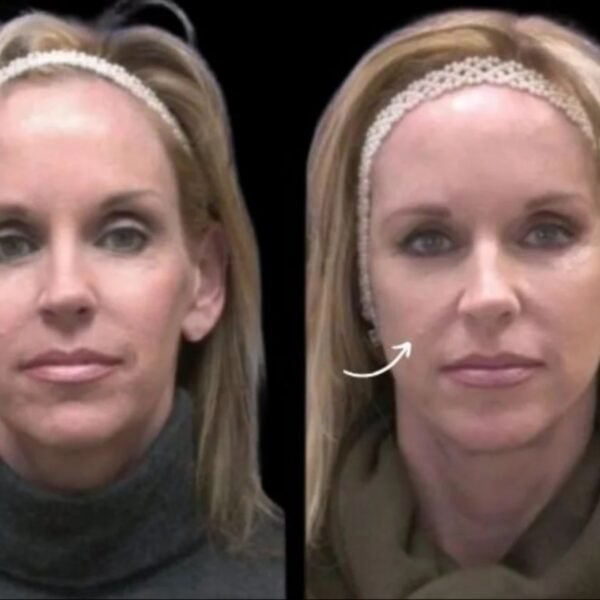 sculptra fillers in dubai