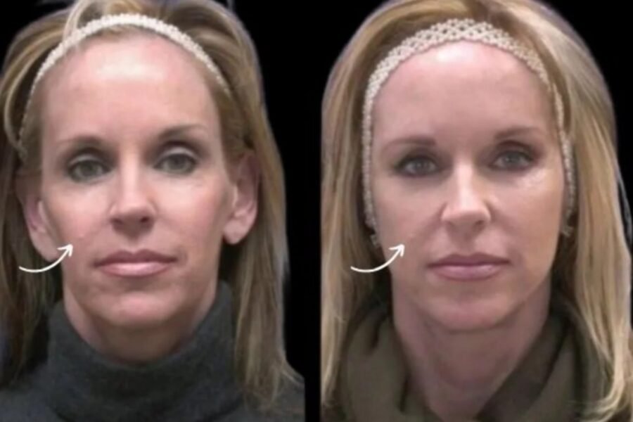 sculptra fillers in dubai