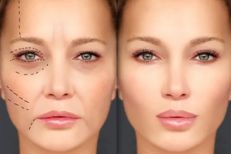 Fillers for Mouth Wrinkles