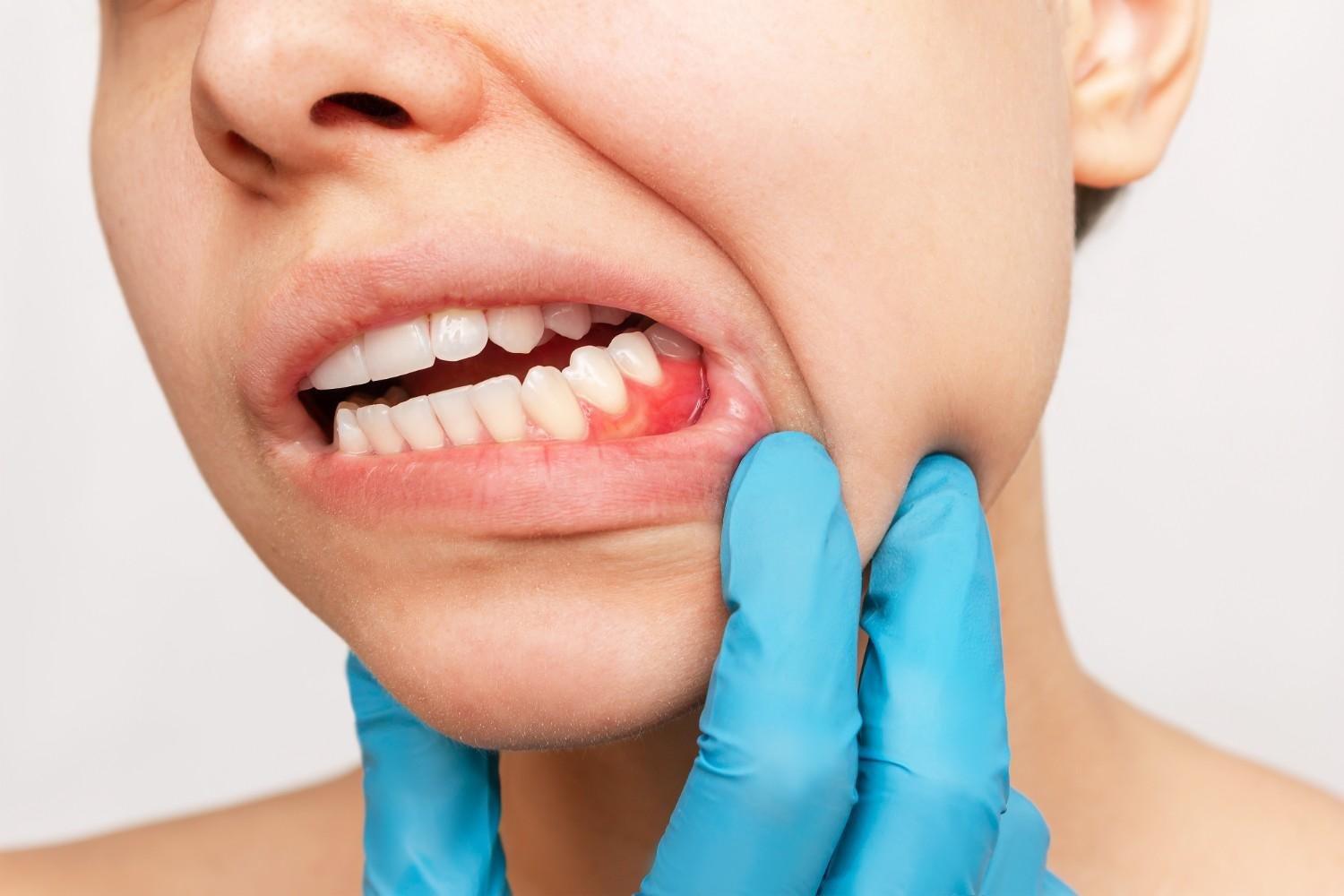 gum repair treatment