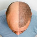 Hair transplant in Dubai