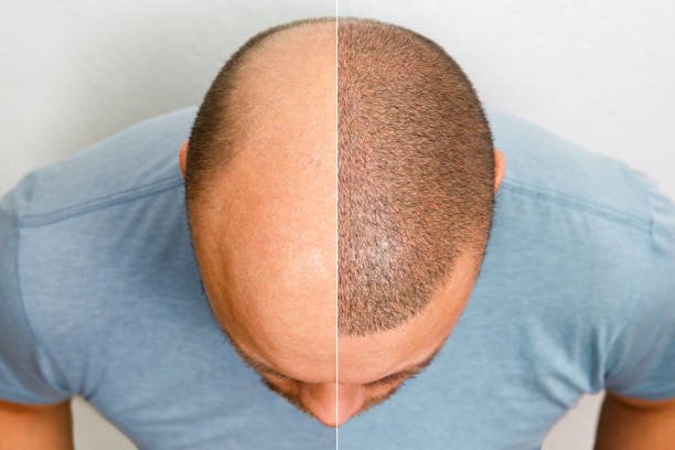 Hair transplant in Dubai