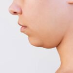 Double Chin Removal in Abu Dhabi