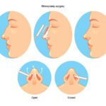 Rhinoplasty in Riyadh