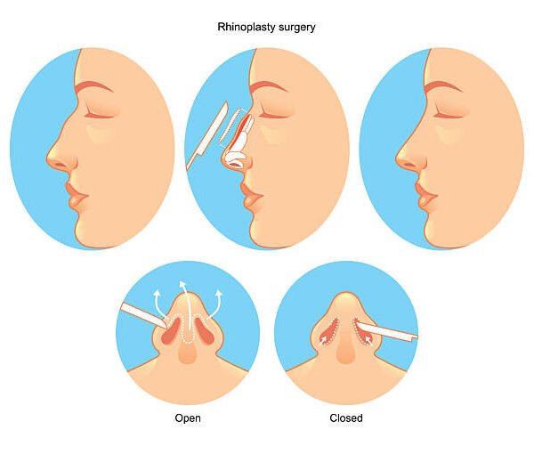 Rhinoplasty in Riyadh