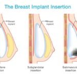 breast implant surgery in Brisbane