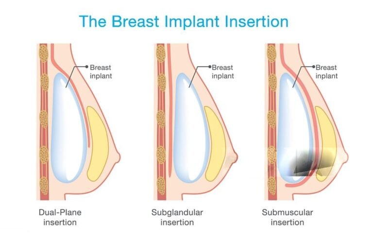 breast implant surgery in Brisbane
