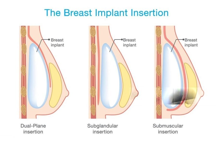 breast implant surgery in Brisbane