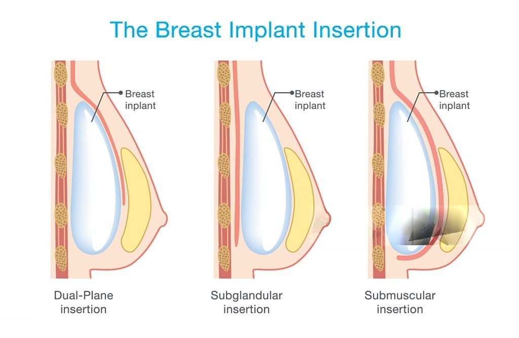 breast implant surgery in Brisbane