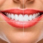 Teeth whitening