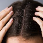 Best Shampoo for dandruff