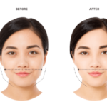 Masseter Botox