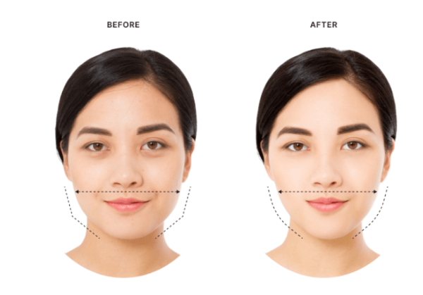 Masseter Botox