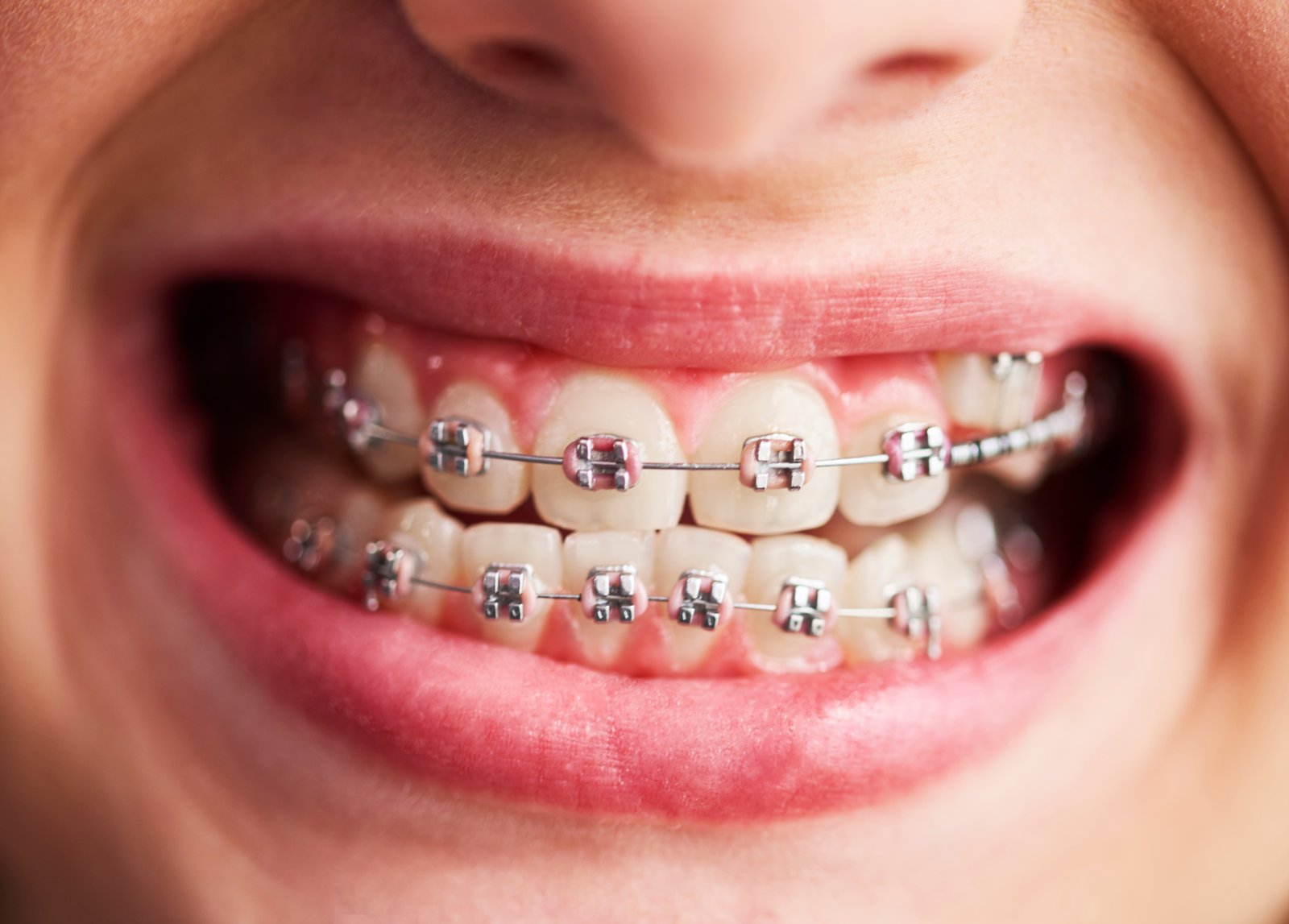 Adult Orthodontic Care: Best Braces in Allen for Professionals