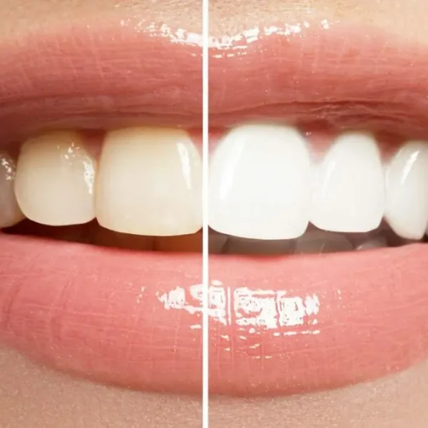 best teeth whitening service in Cudahy