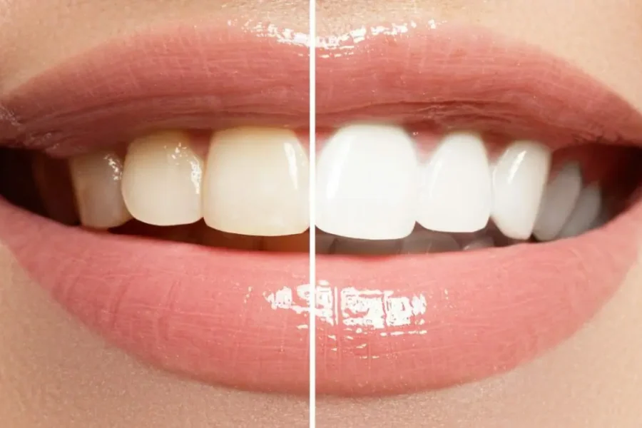 best teeth whitening service in Cudahy