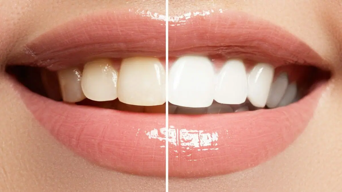 best teeth whitening service in Cudahy