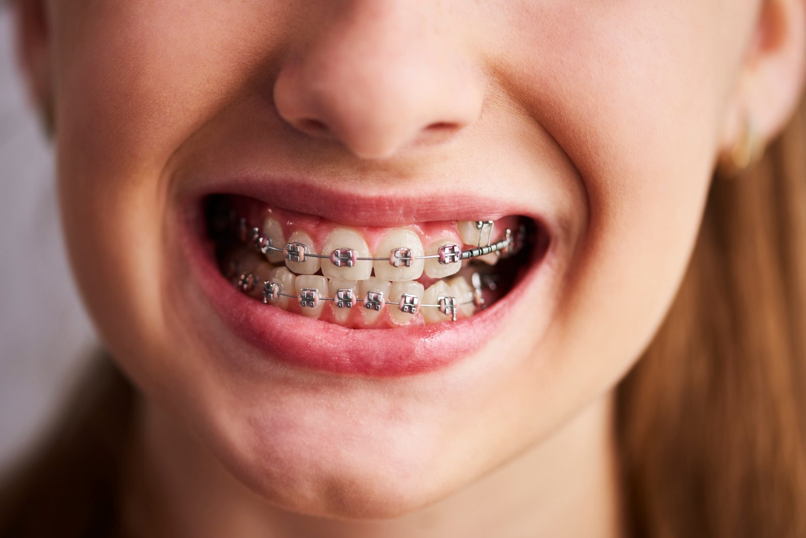 Trusted Orthodontists Offering Braces in Kendall